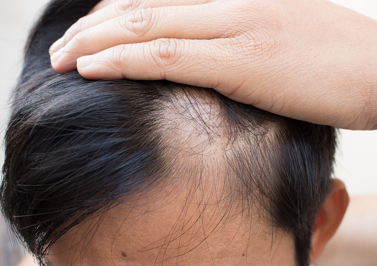 Platelet Rich Plasma for Hair Loss Fremont OH - Growth Factors